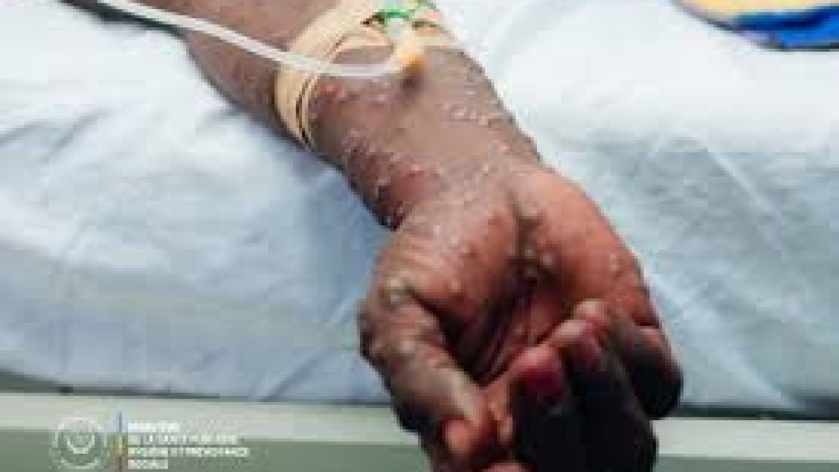 Santé — Environ 300 cas de Mpox enregistrés par semaine en RDC