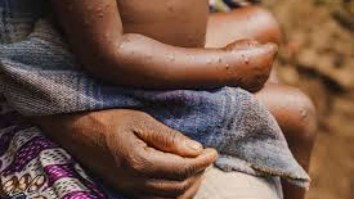 Santé — La guerre entrave la lutte contre le Mpox dans l'est de la RDC